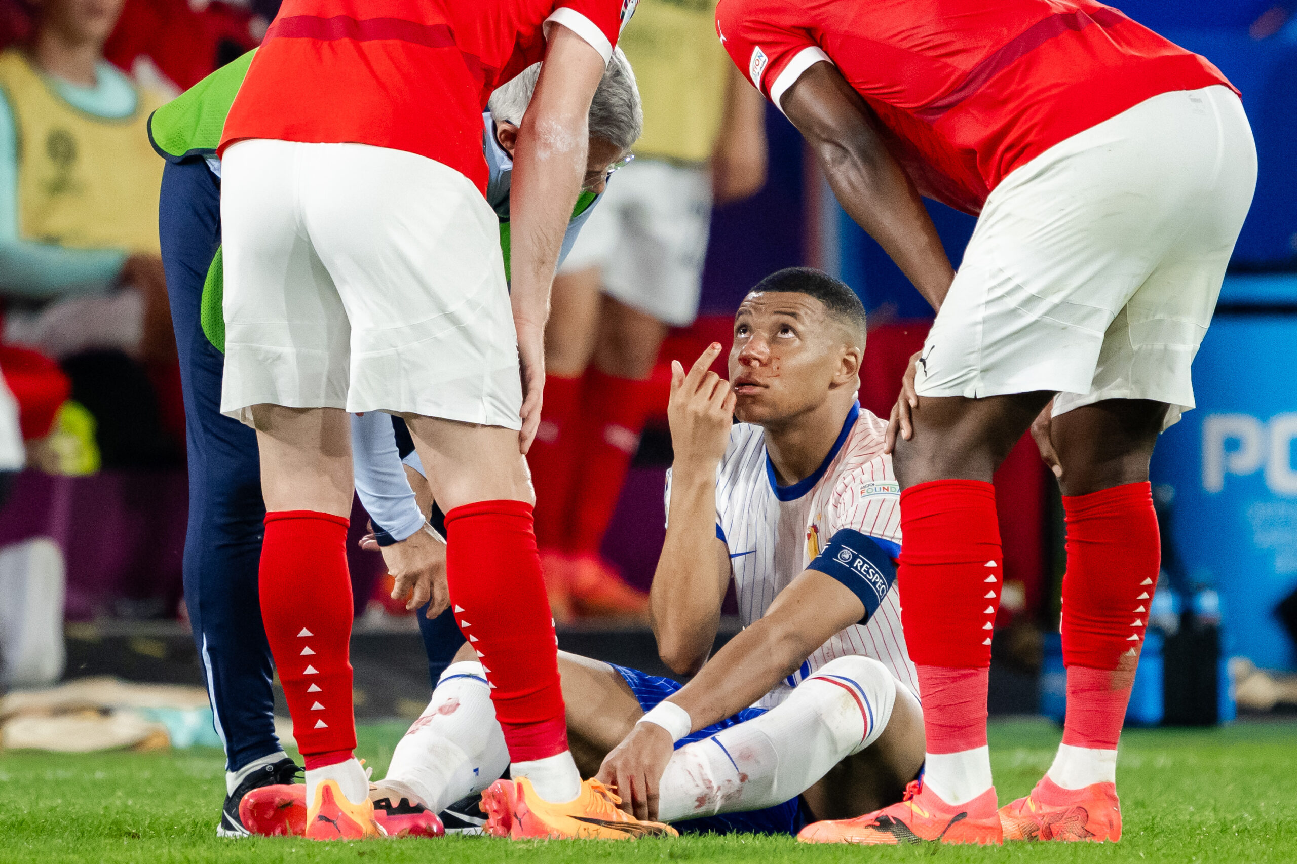 KYLIAN MBAPPÉ SUFRE GRAVE LESIÓN EN LA EUROCOPA 2024