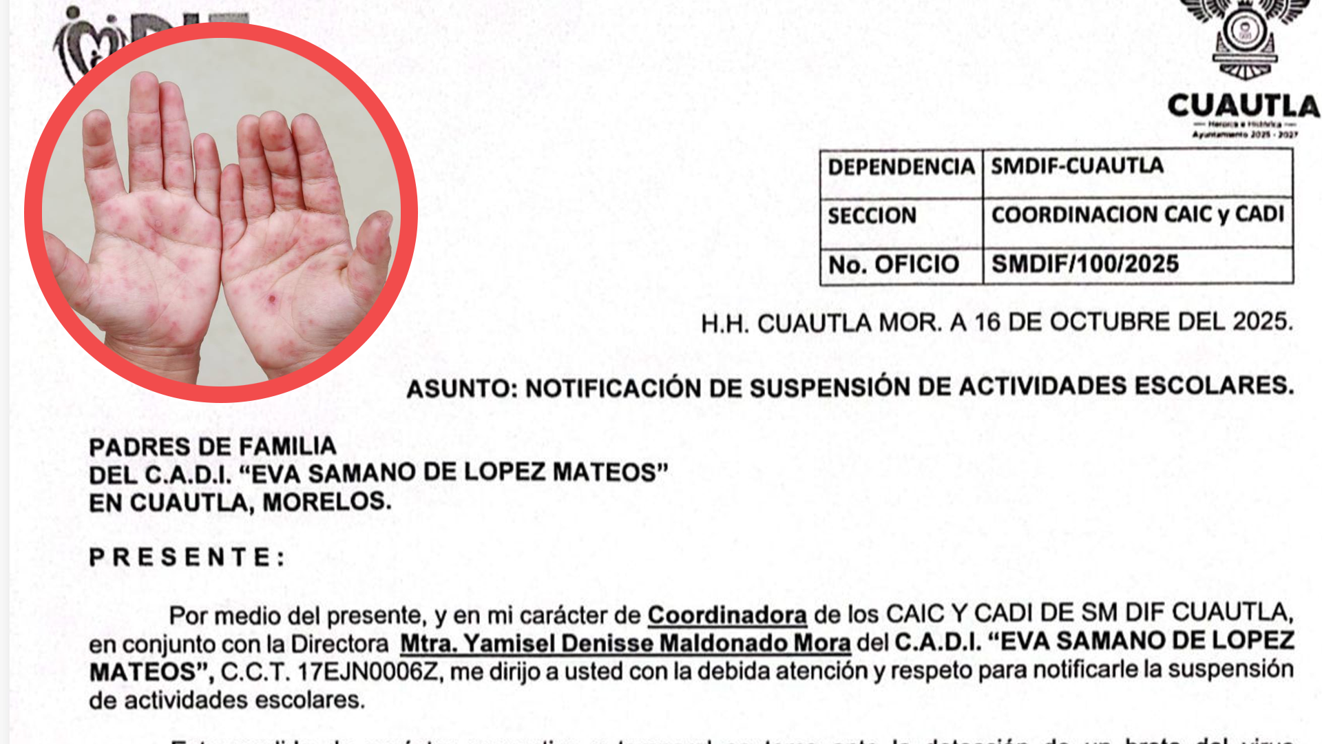 SUSPENDEN CLASES POR COXSACKIE EN EL CADI EVA SÁMANO DE CUAUTLA