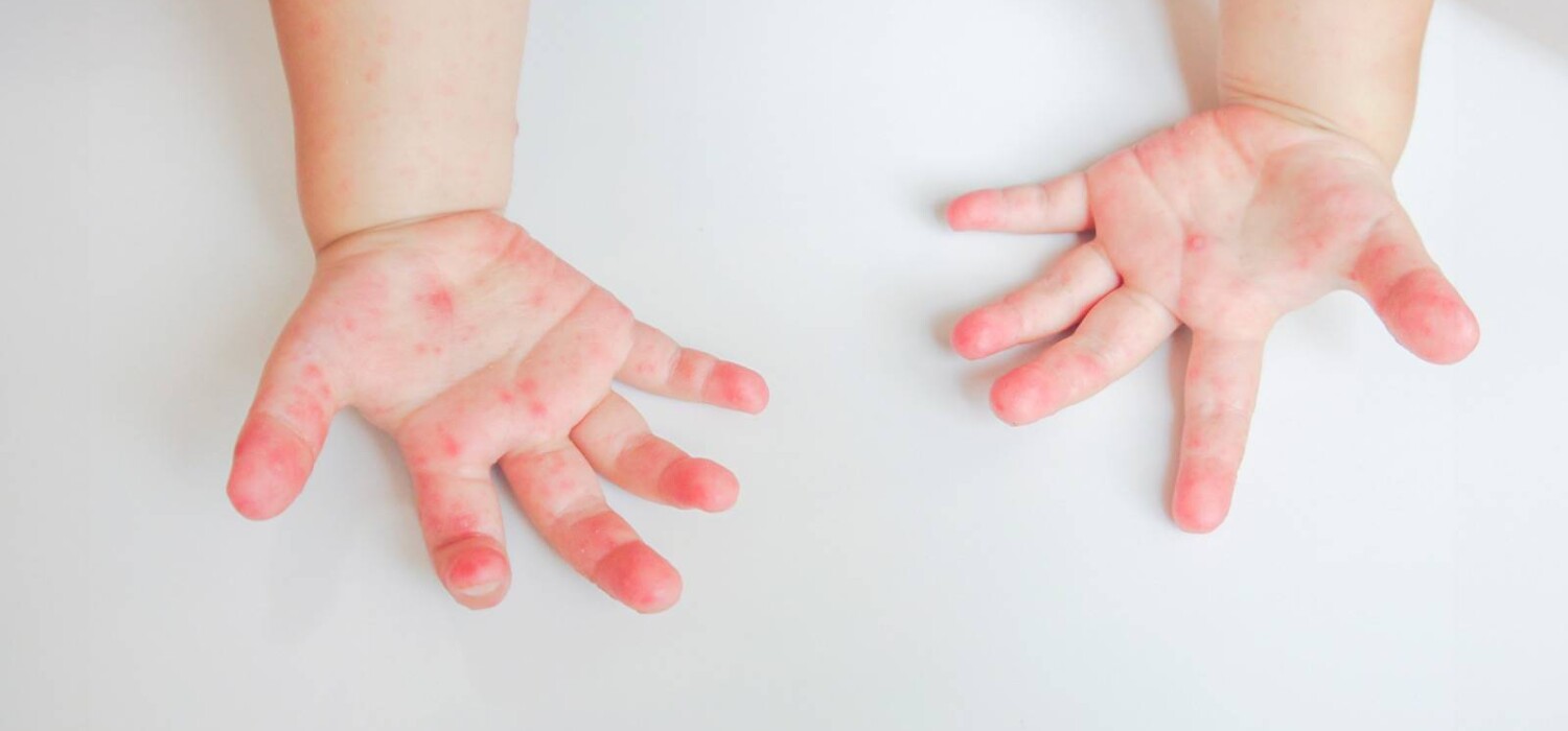 CUAUTLA REGISTRA CASOS DE COXSACKIE